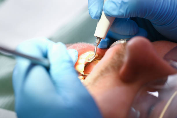 Best Emergency Dental Care for Abscessed Tooth in Wona Lake, IN